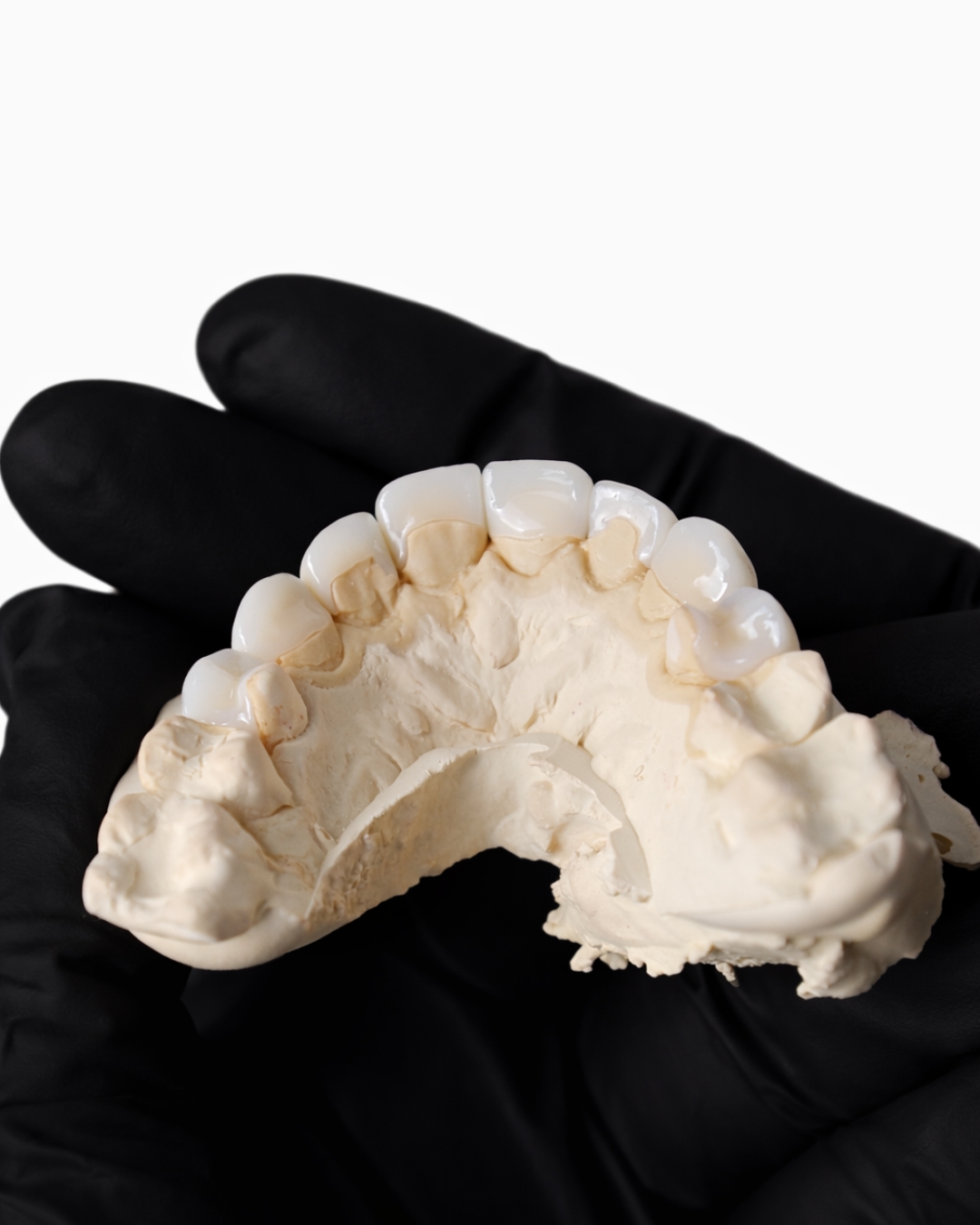 Emax Veneer